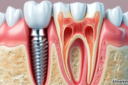 Dental Implants In Portugal